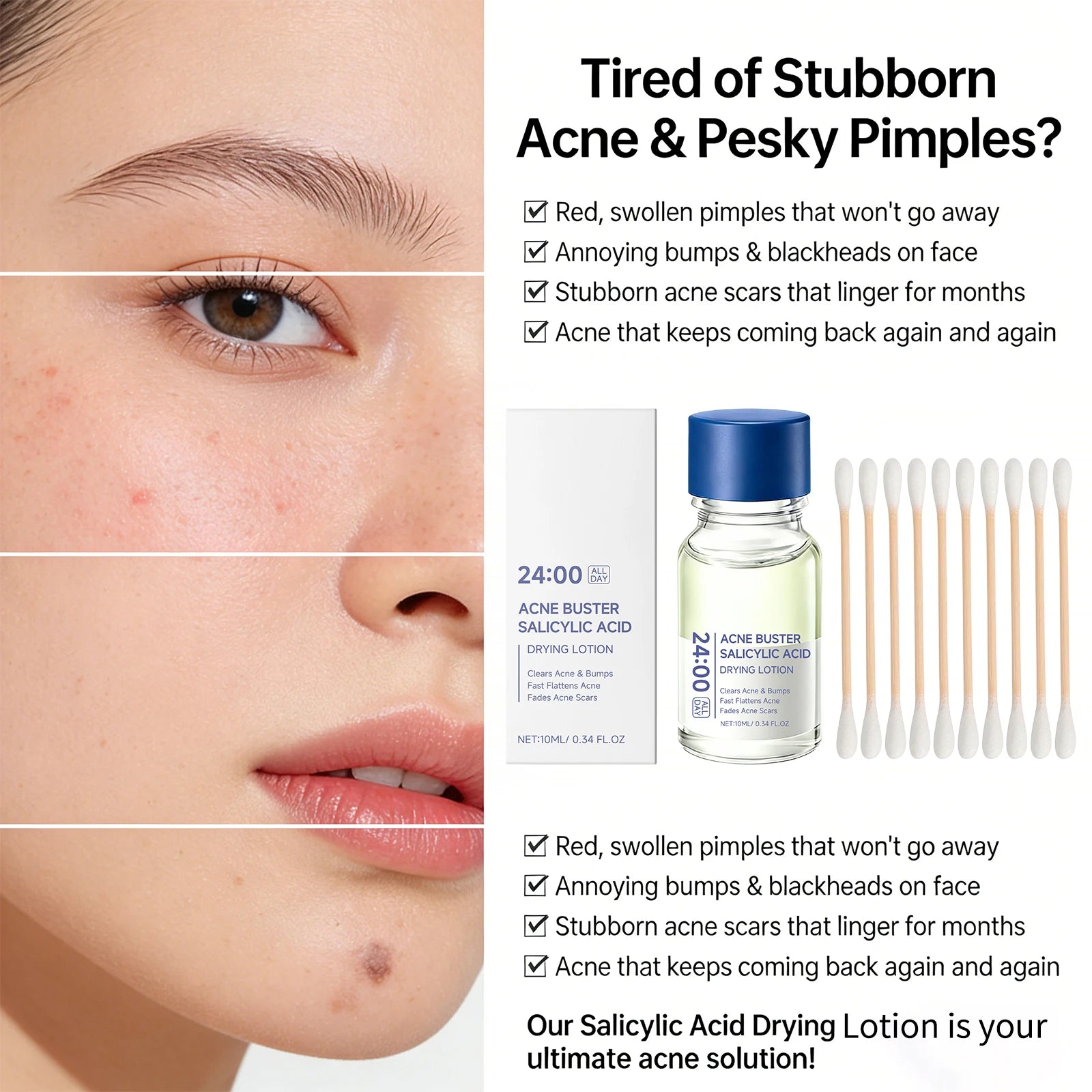 Salicylic Acid Acne Drying Lotion Pimple Remover Serum Fade Marks Shrink Pores Oil Control Face Care with Swabs
