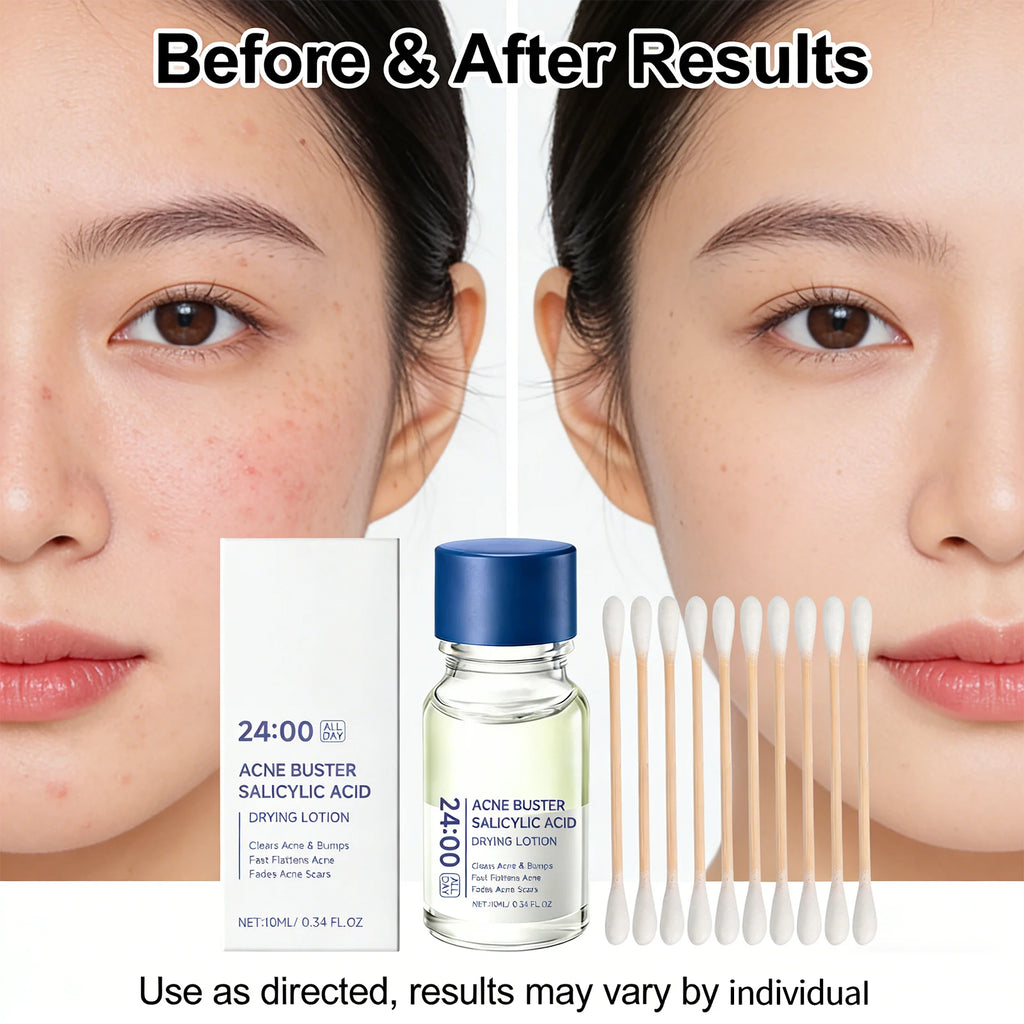 Salicylic Acid Acne Drying Lotion Pimple Remover Serum Fade Marks Shrink Pores Oil Control Face Care with Swabs